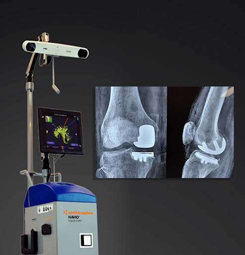 Best Robotic Assisted Knee Replacement surgeon in Mulund