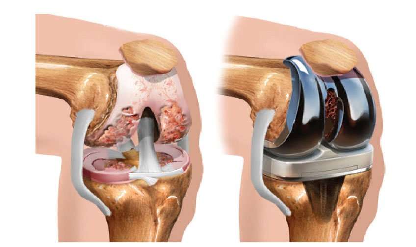 Best TKR Surgeon in Jaipur, Total Knee Replacement Surgery ...