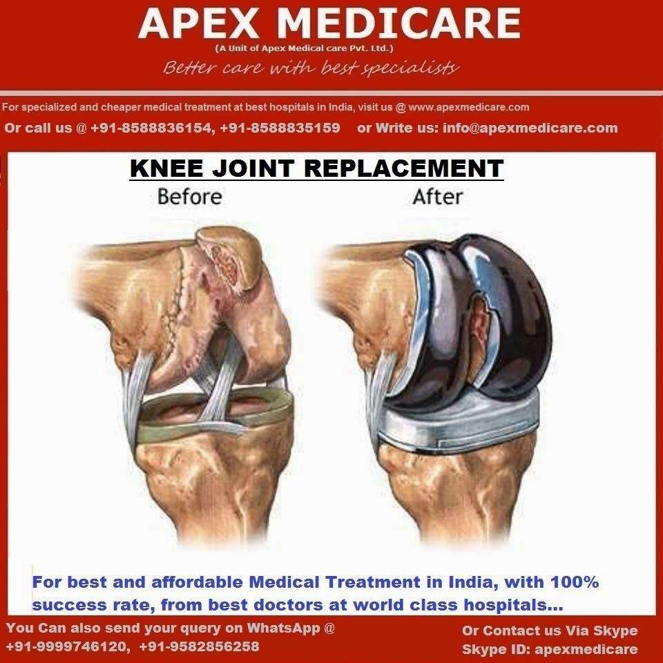 BestTreatment in India: High Quality Total knee Replacement Surgery in ...