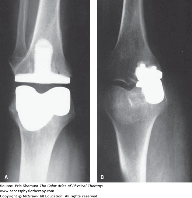 Bilateral Knee Pain Icd 9