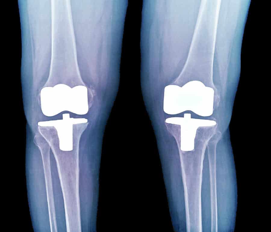Bilateral Total Knee Replacement Photograph by Zephyr/science Photo Library
