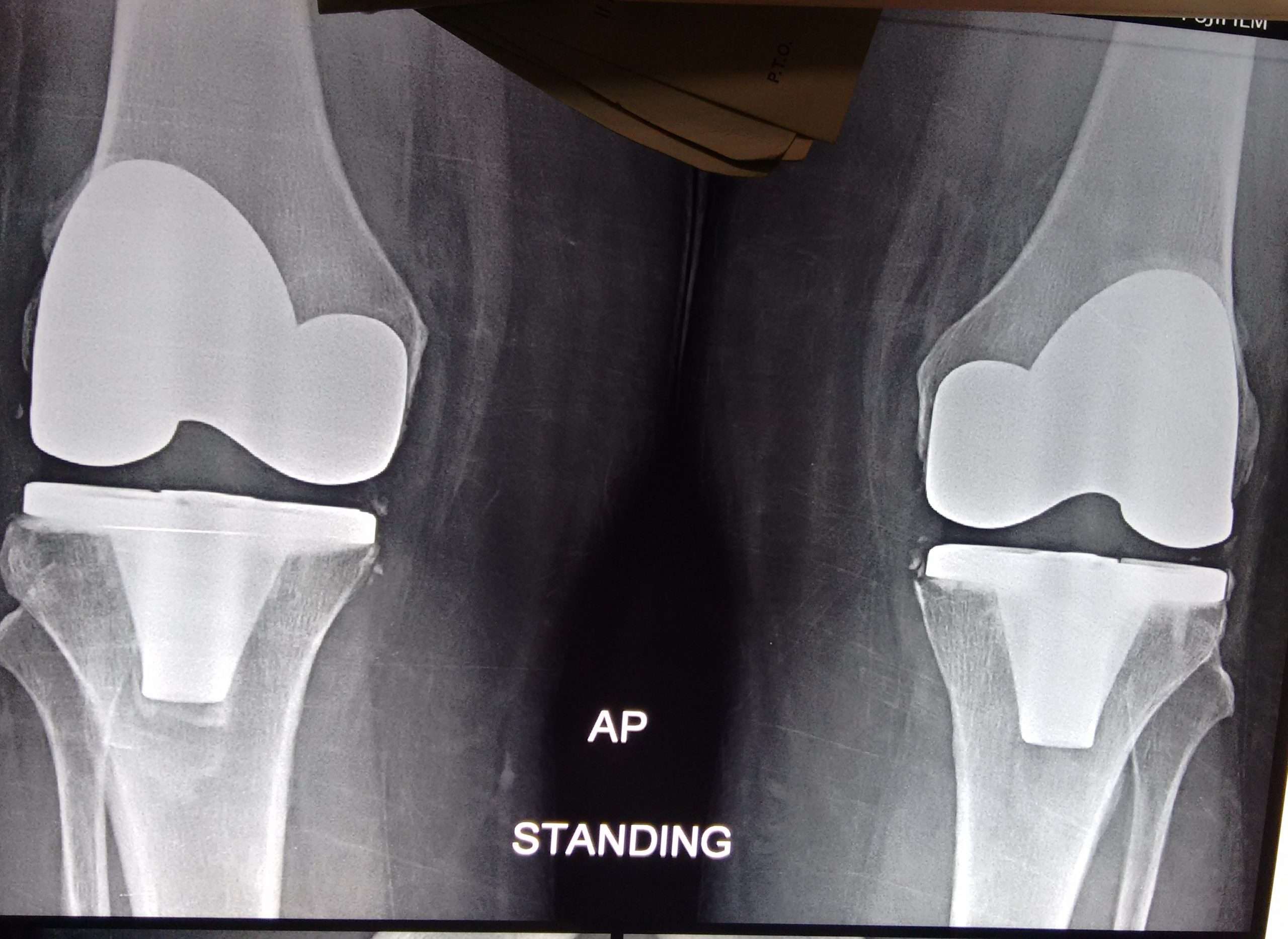 Bilateral total knee replacement (TKR) in an obese lady ...
