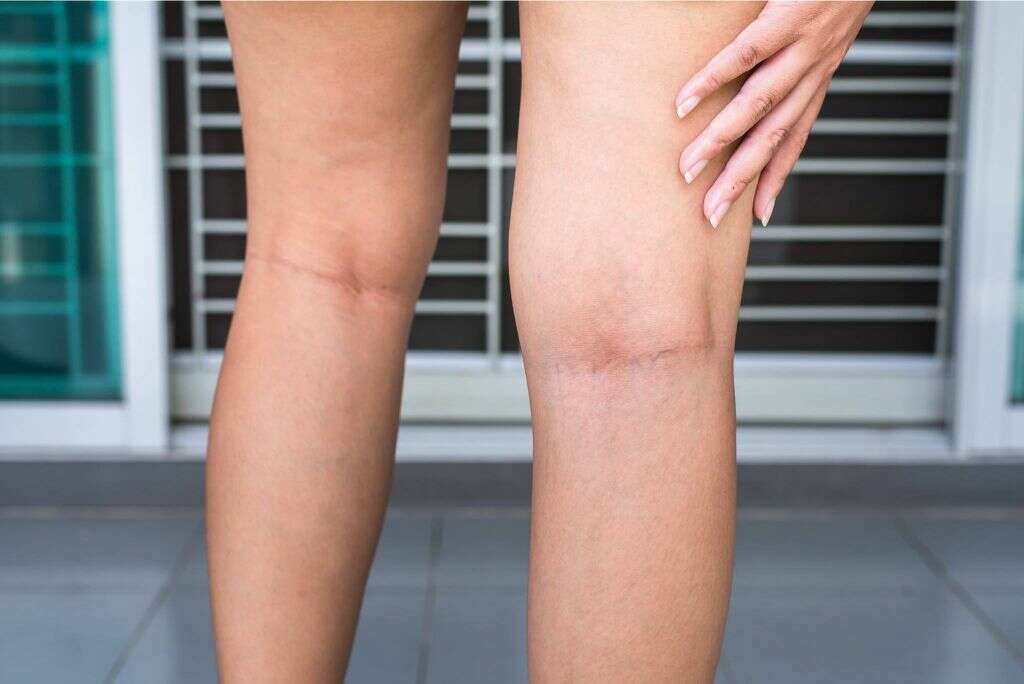 Blood Clot In Leg: 10 Blood Clot in Leg Symptoms