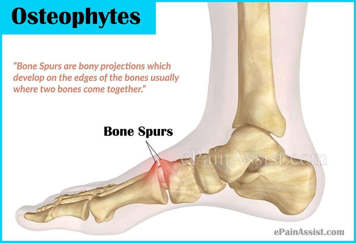 Bone spur on back of foot pictures