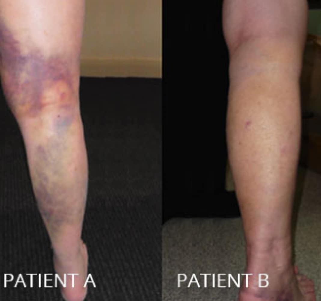 Bruising after Joint Replacement Surgery