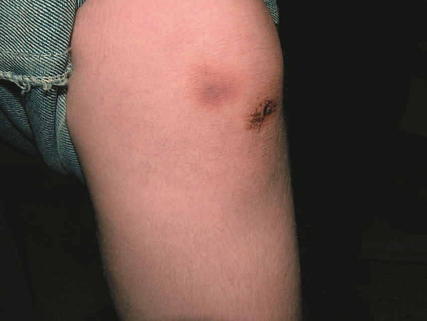 Bruising with minor trauma is seen over the left knee ...