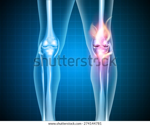Burning Knee Painful Knee Normal Knee Stock Illustration 274144781