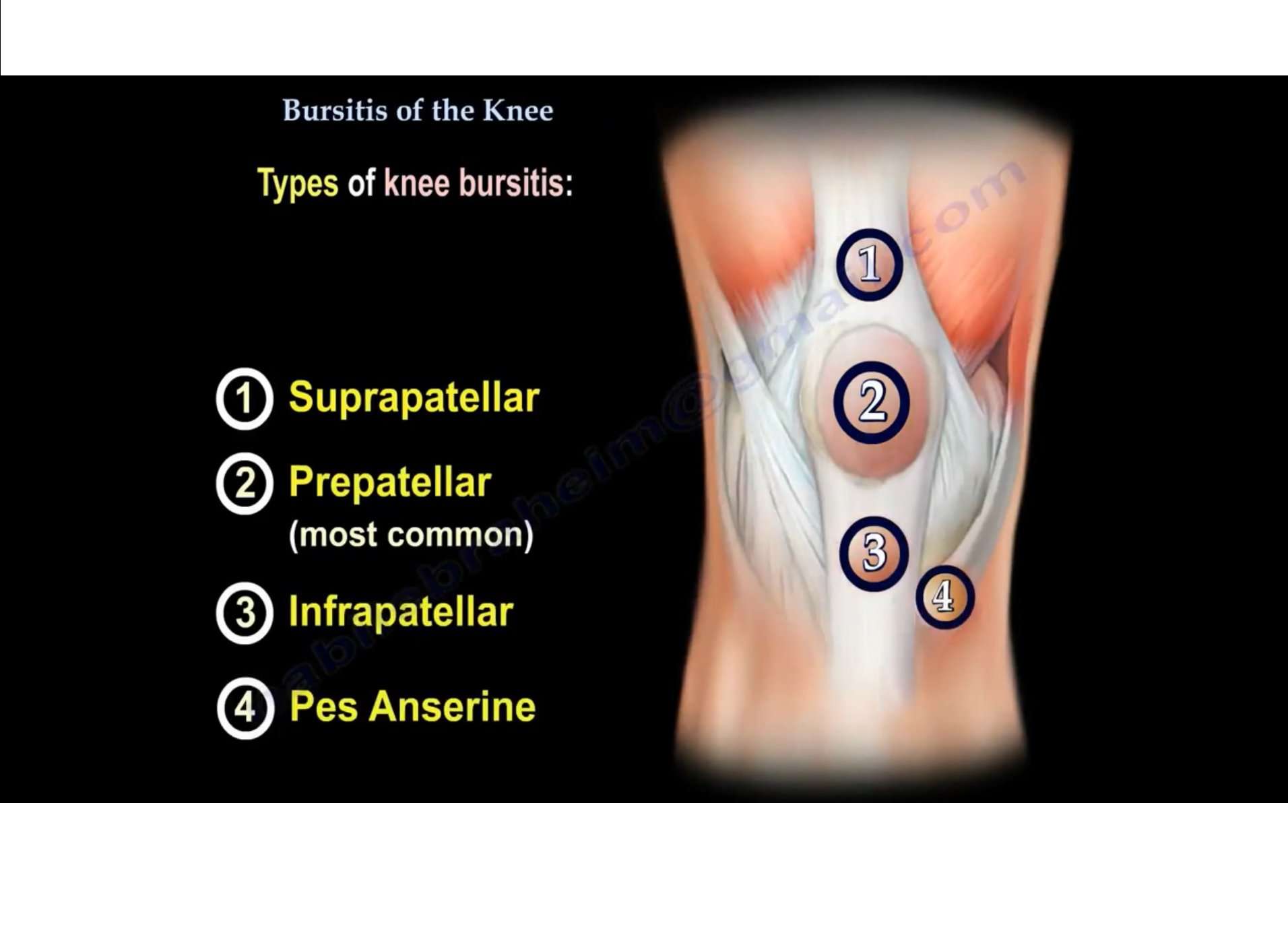 Bursitis of Knee â OrthopaedicPrinciples.com