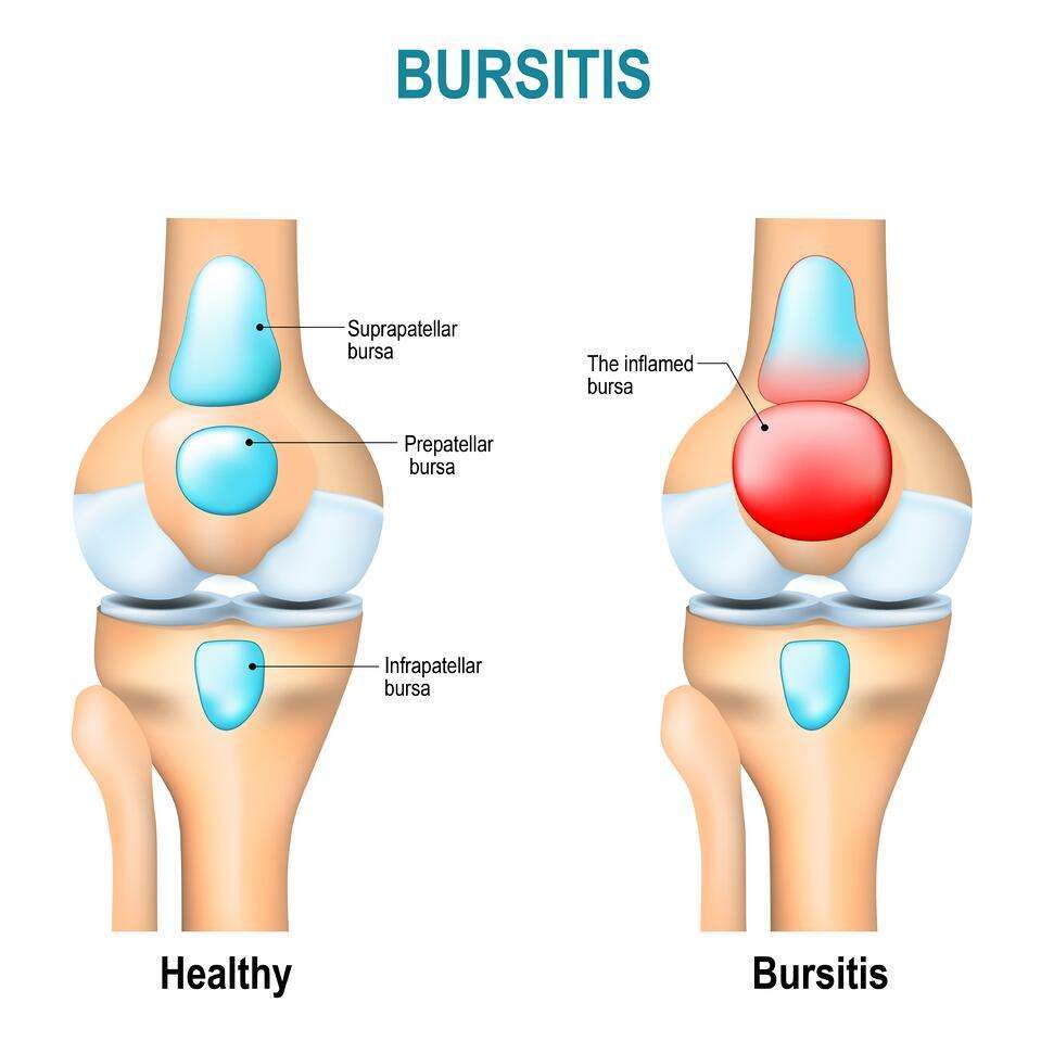 Bursitis: What Is It, Causes, and Areas of the Body Affected