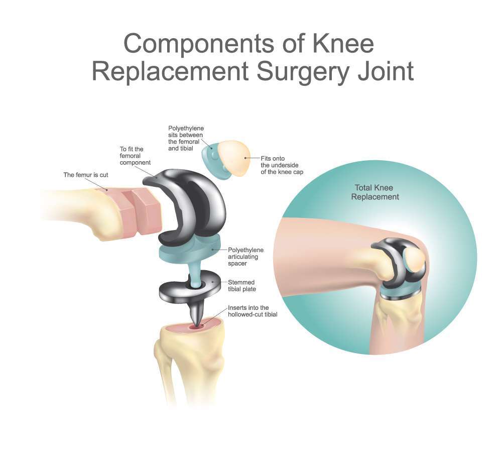 Can adjustable beds help knee replacement recovery?