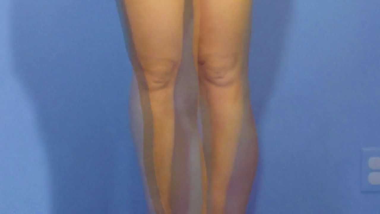 Can I Get Rid of the Fat Around My Knee with Liposuction ...