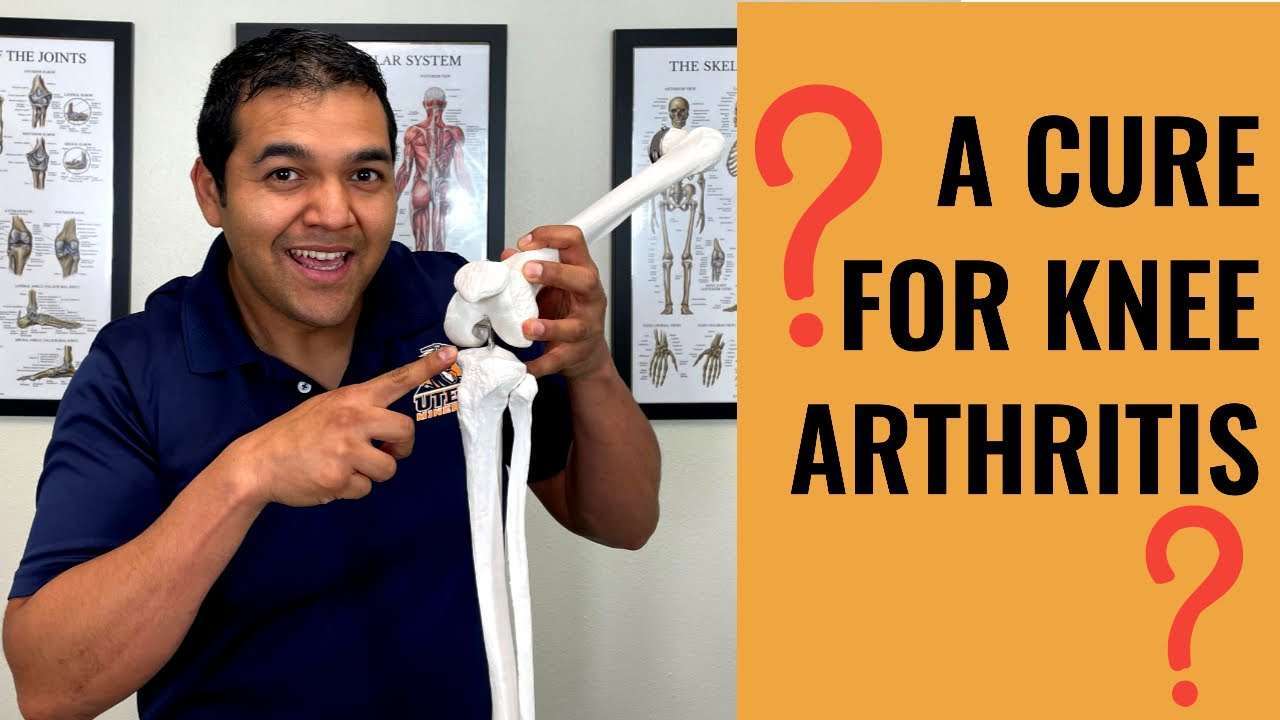 Can Knee Arthritis Be Cured [What Doctors CANT Tell You ...