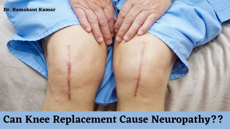 Can Knee Replacement Cause Neuropathy ? Know Here!
