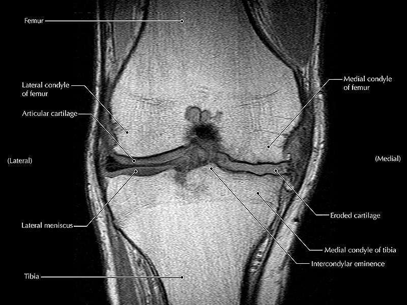 Can MRI Predict Worsening Knee Symptoms and Joint Damage?