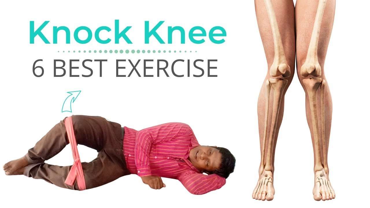 Can Physiotherapy Cure Knock Knees