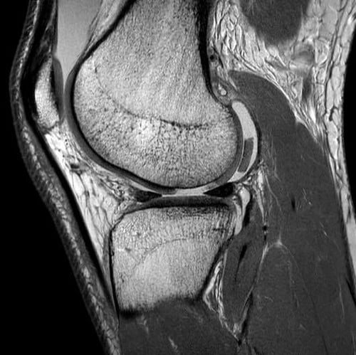 Can you see anything out of place on this knee MRI? ANSWER