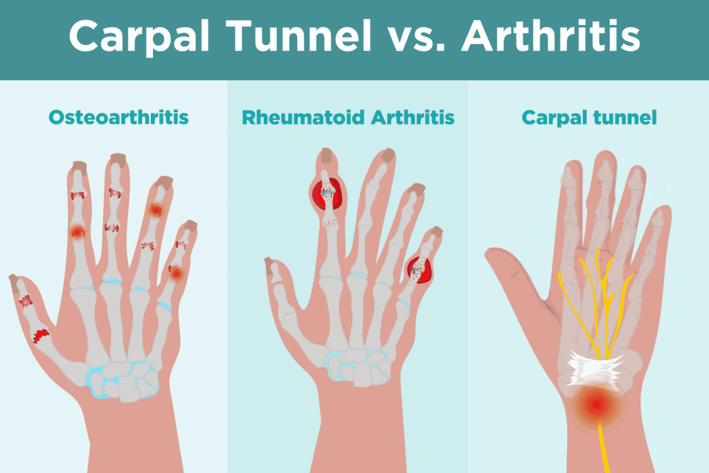 Carpal Tunnel Syndrome vs. Arthritis: Whatâs the Difference?
