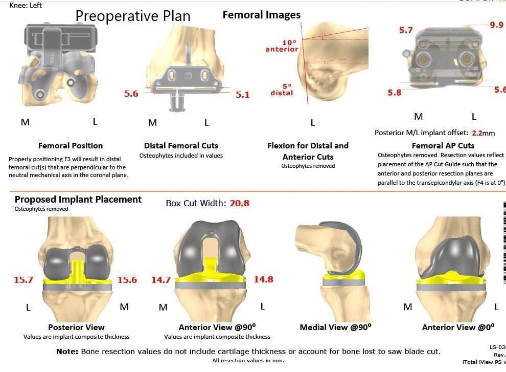 Case study: Left Customized Knee Replacement in an 80