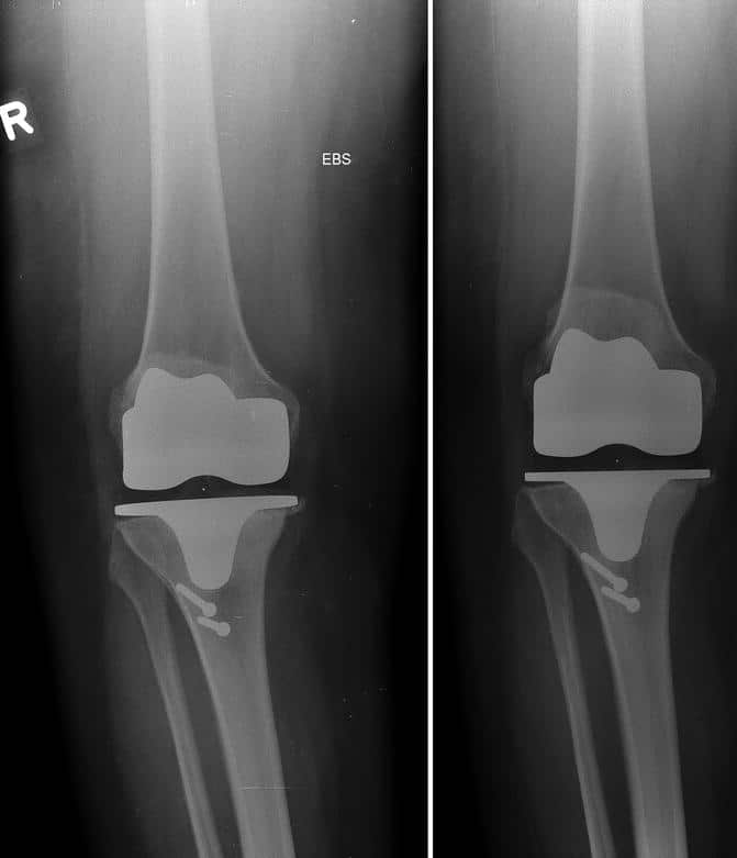 Causes and Diagnosis of Aseptic Loosening After Total Knee Replacement ...