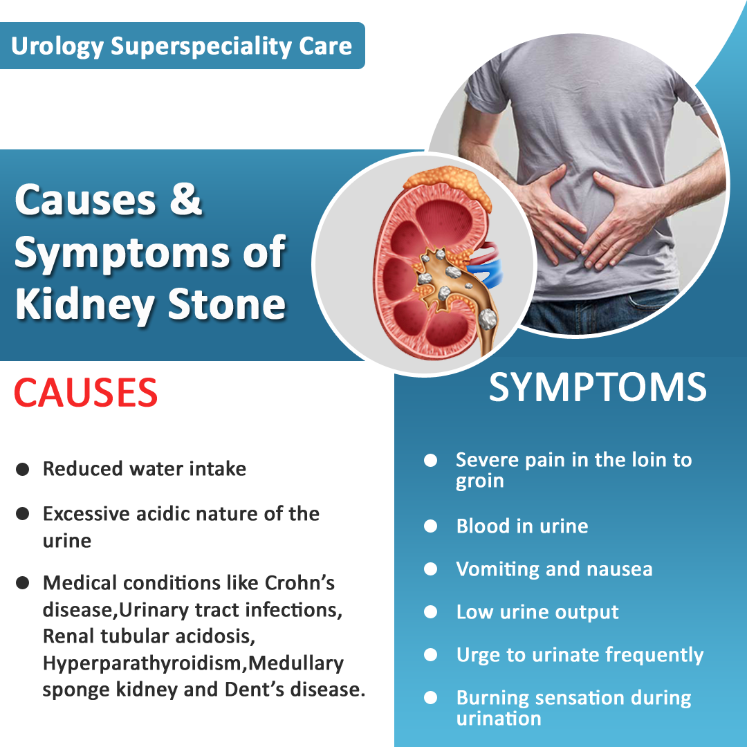 Causes &  Symptoms of Kidney Stone