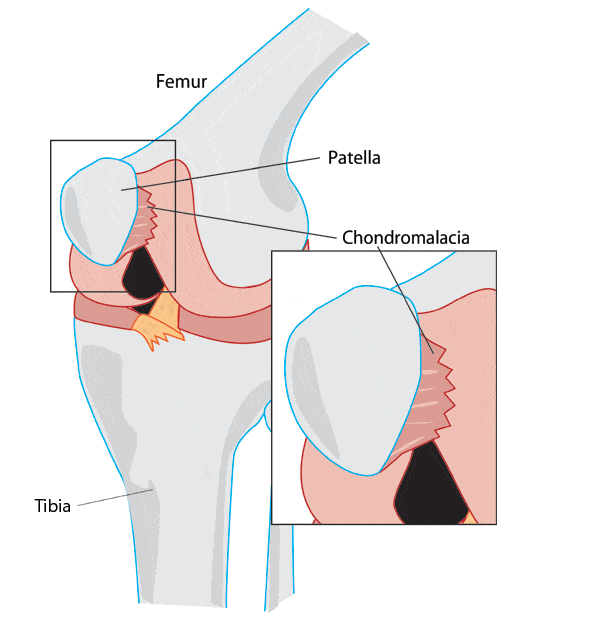 Chondromalacia patella (Patella