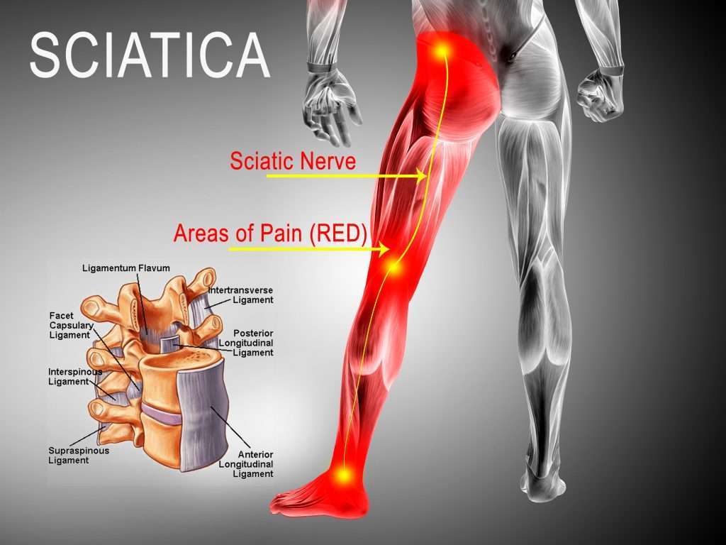 Chronic Back Pains  Cervical Spondylosis, Disc Herniation ...