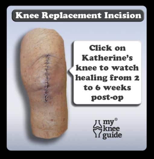 Click on Katherines knee to see the animation of her knee replacement ...
