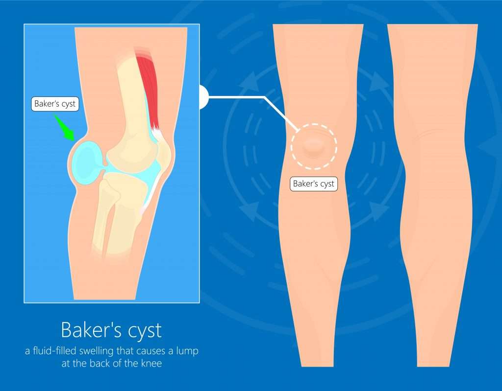 Common Knee Injuries