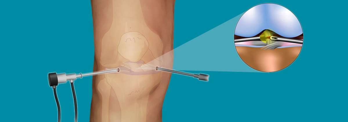 Common treatments with knee arthroscopy include: