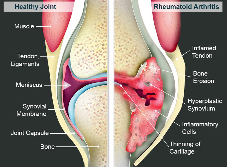 Common Types Of Arthritis That Affect The Knee  cyriaxphysio