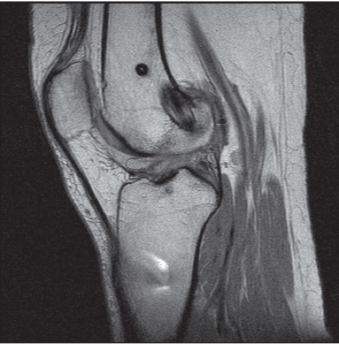Complications of Knee Arthroscopy