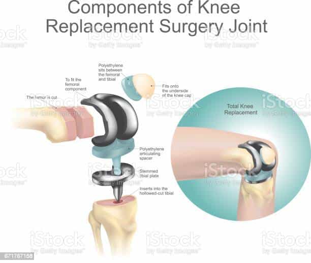 Components Of Knee Replacement Surgery Joint Stock Illustration ...