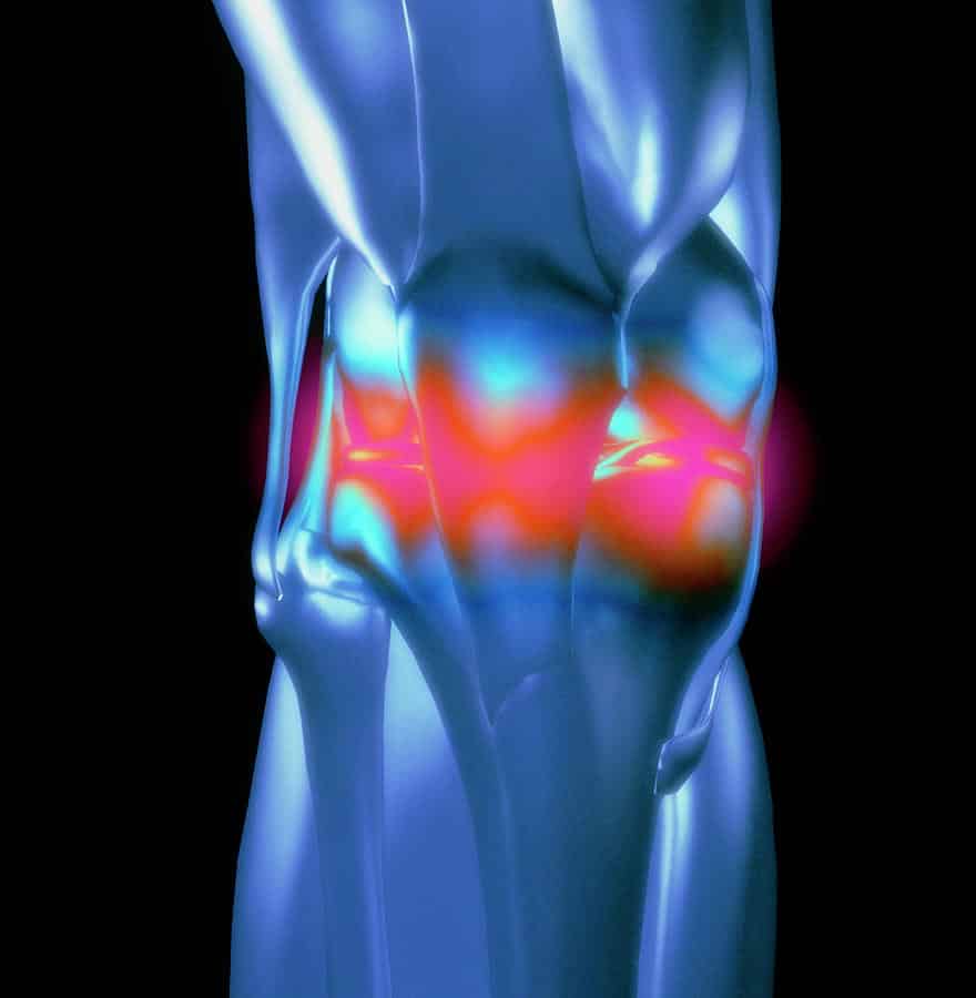 Computer Artwork Of Knee With Rheumatoid Arthritis Photograph by Alfred ...