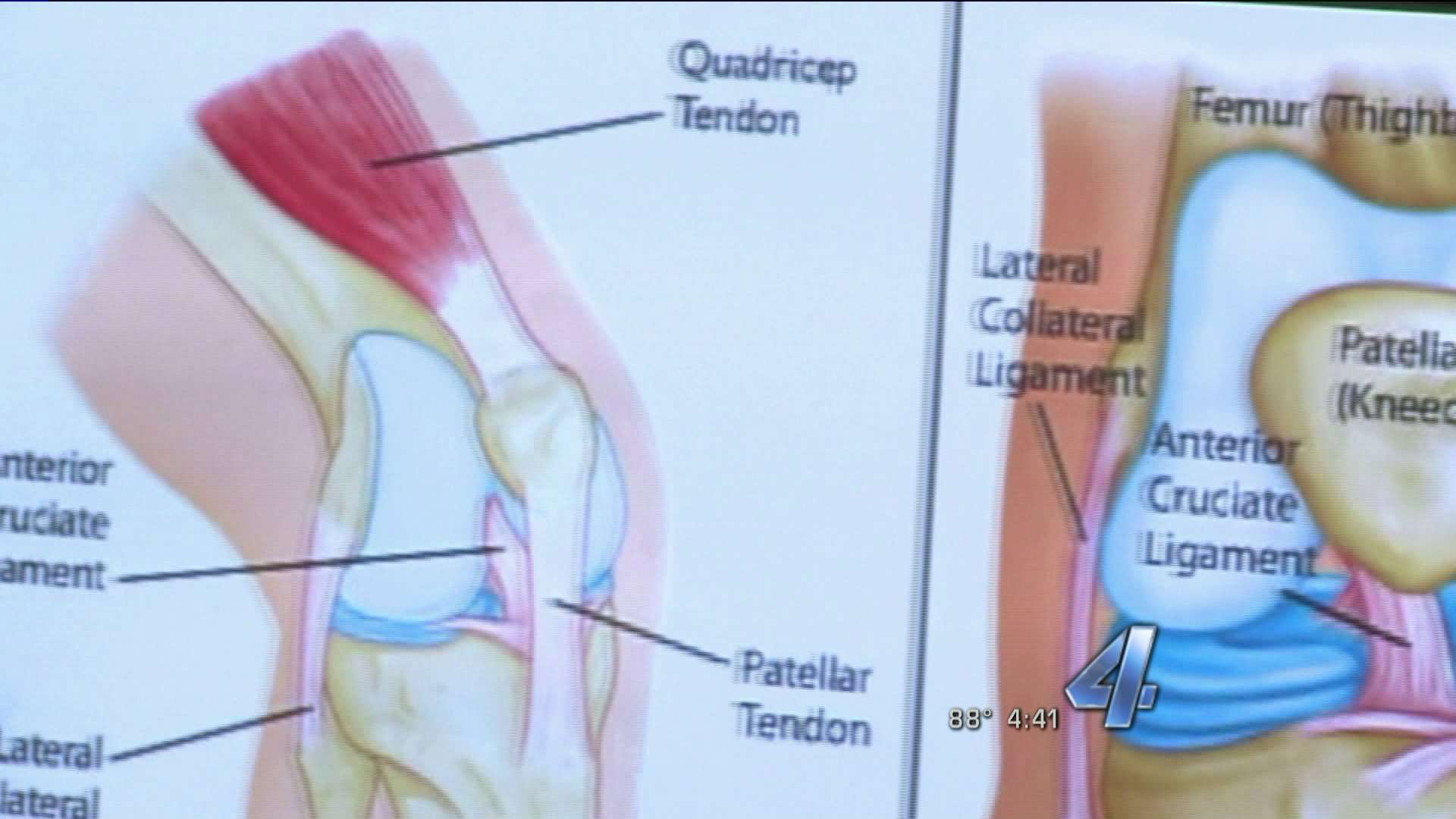 Coolief procedure providing pain relief to chronic knee ...