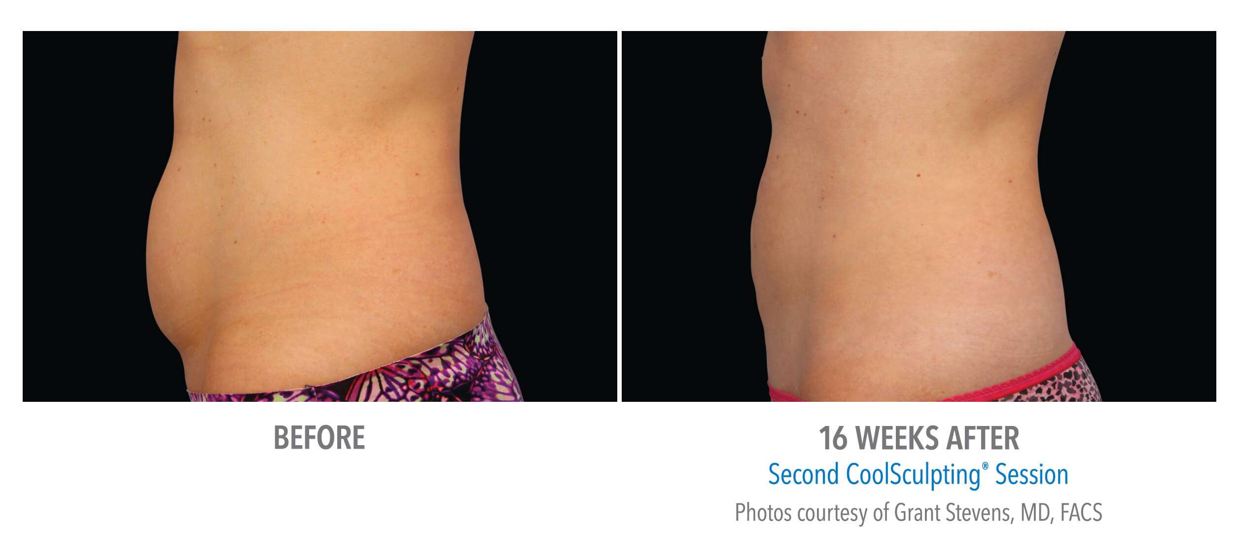 CoolSculpting Rochester NY