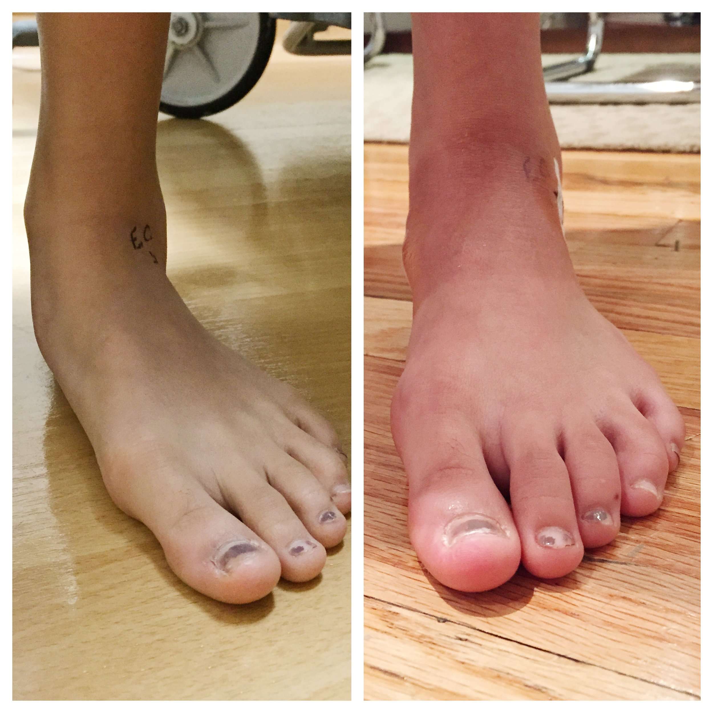 Correcting a Flexible Pediatric Flat Foot to Avoid Adult ...