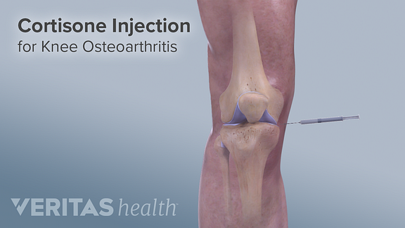Cortisone Injections (Steroid Injections)