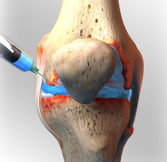Cortisone Knee Injections London