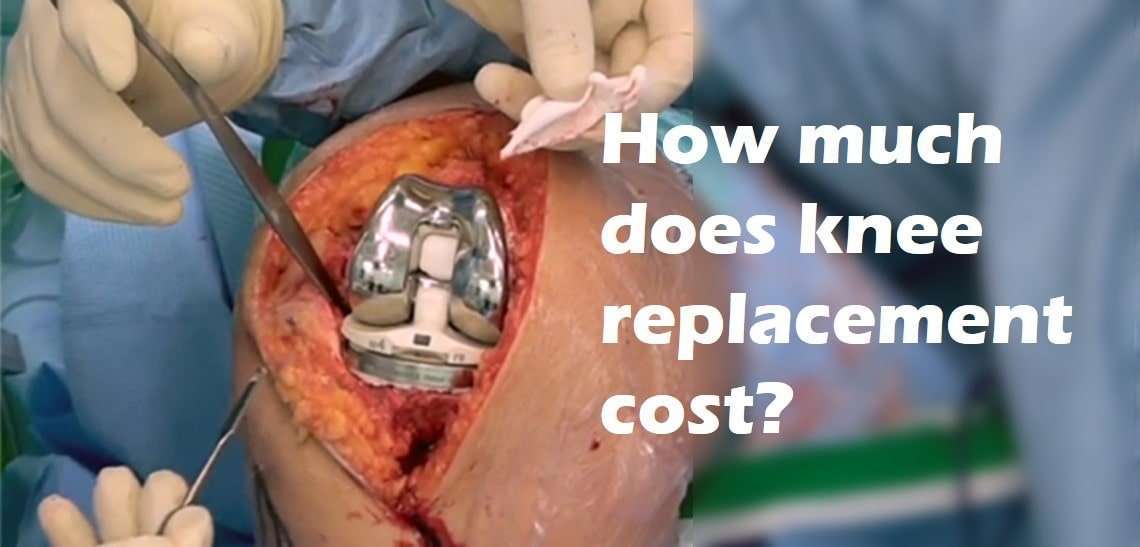 cost of knee replacement