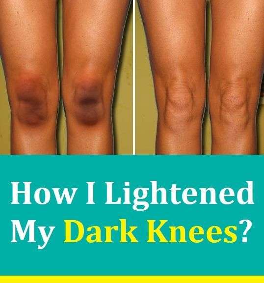 Dark Knees: What Causes Them and How to Lighten Your Knees ...