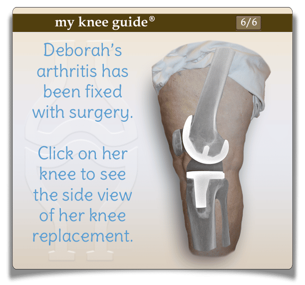 Deborah: Deborah can finally exercise again with her new knee