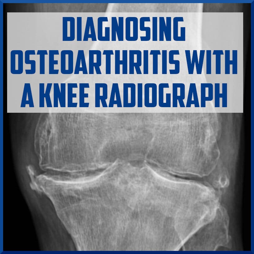 Diagnosing Osteoarthritis with a Knee Radiograph