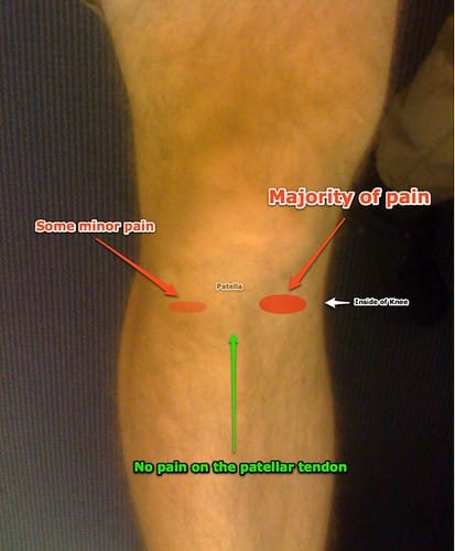 Diagram of My Knee Pain