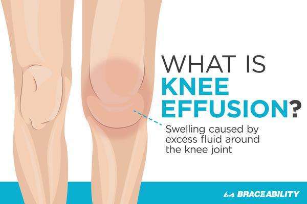 Discover the Difference: Knee Effusion, Water on the Knee ...
