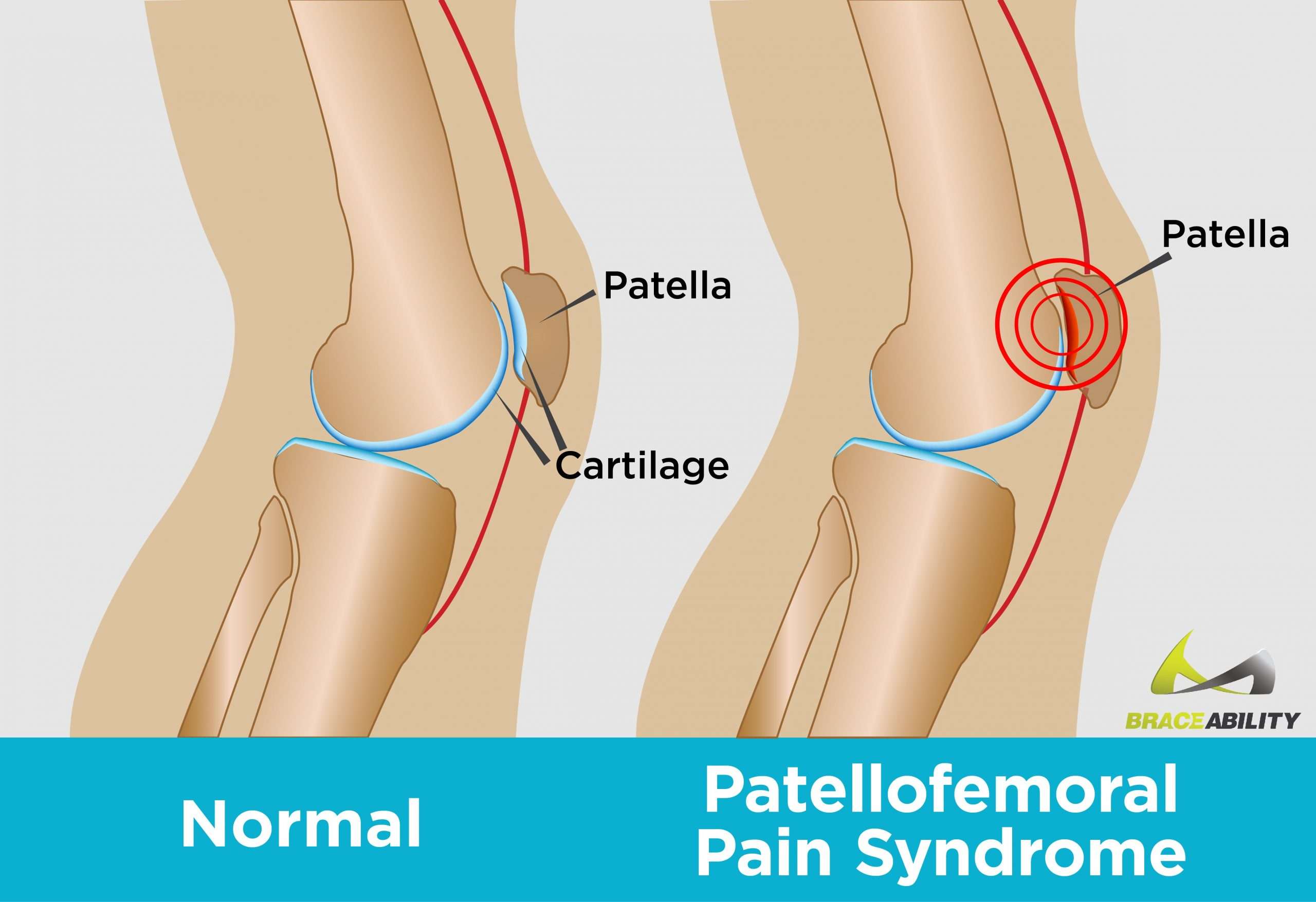 Do I Have Patellofemoral Pain Syndrome? Symptoms &  Causes