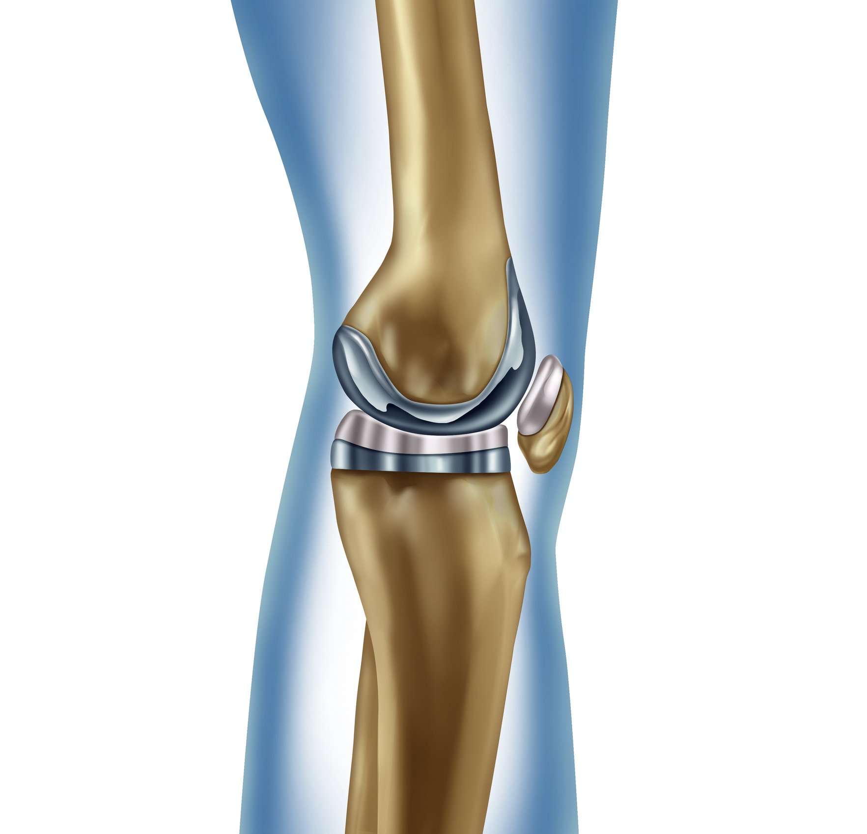 Do I Need a Full or Partial Knee Replacement Surgery ...