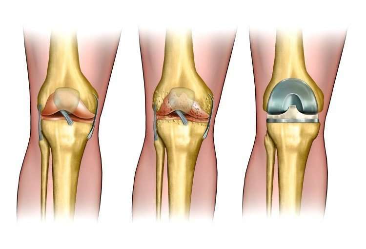 Do I Need a Knee Replacement?
