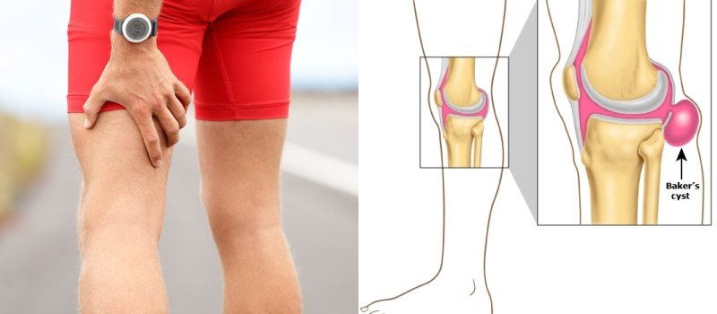 Do You Know What Causes Pain Behind the Knee and How to ...