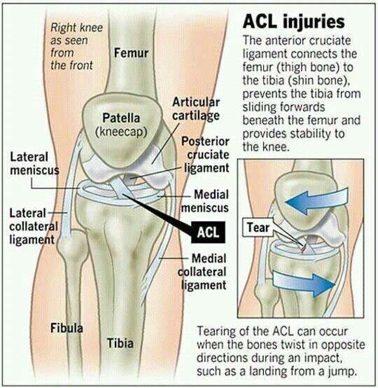 Does a partial ACL ligament tear heal on its own? Would a ligament get ...