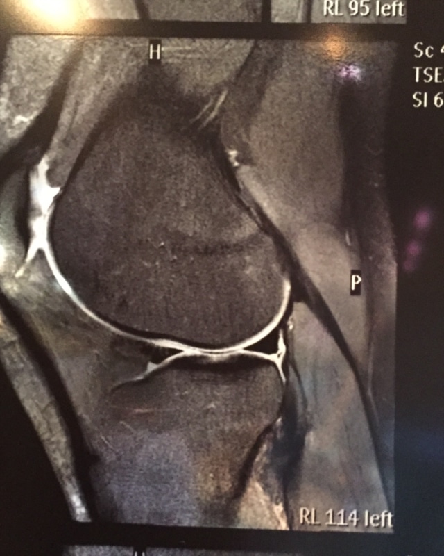 Does my MRI look normal to you? (Cant walk or straighten knee after ...